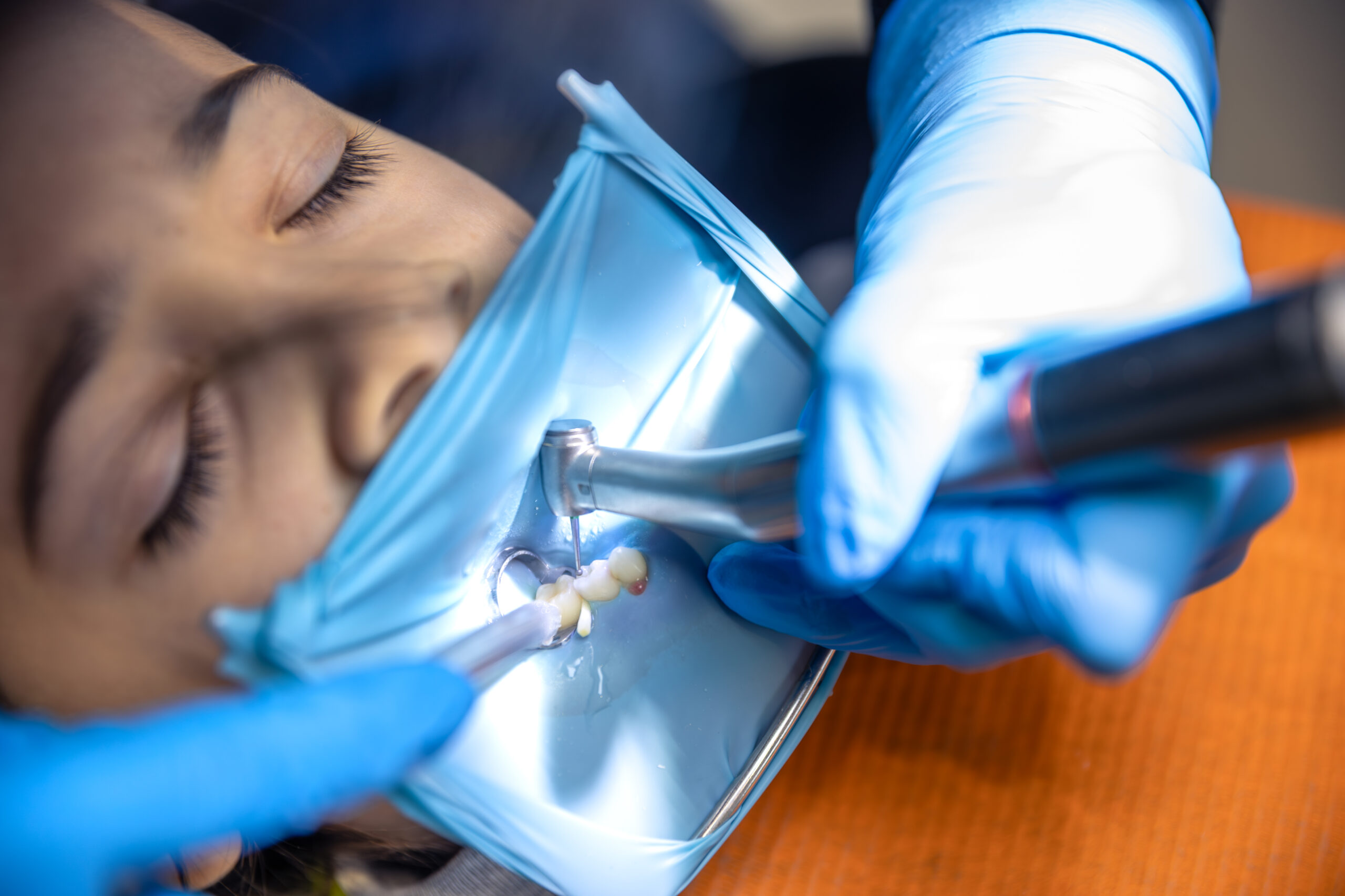 The dentist treats the child’s tooth using a rubber dam. Close-up of tooth treatment.