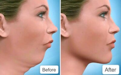 Corrective Jaw Surgery: Who Needs It and How It Helps