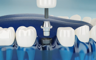 What are dental implants and what are its benefits over other traditional dentures and bridges ?
