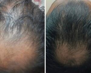 best hair fall treatment trivandrum