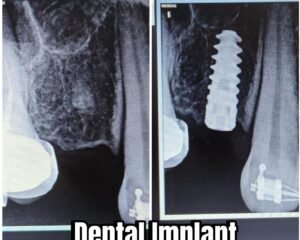 Dental Implants Trivandrum