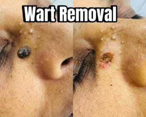 Wart Removal Treatment