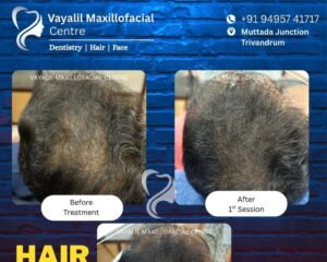 best hair regrowth treatmentT rivandrum